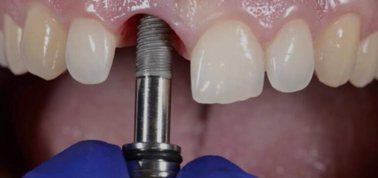 implantes dentales en méxico