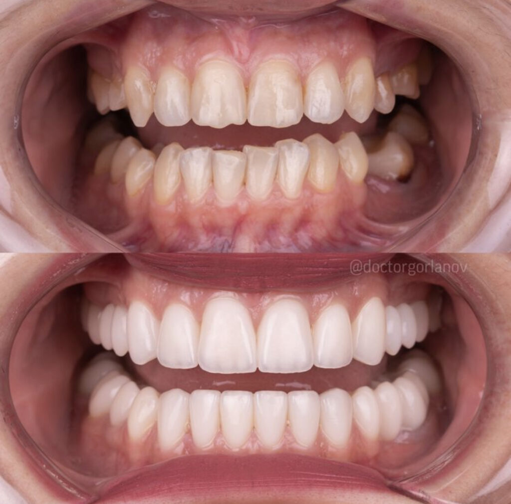 carillas dentales