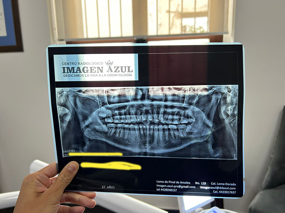 extracciones dentales estudios previos