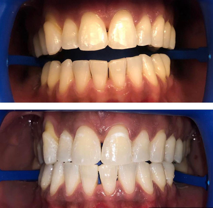 Blanqueamiento dental