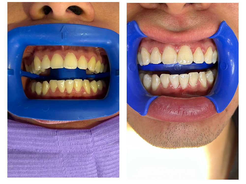 blanqueamiento dental en querétaro