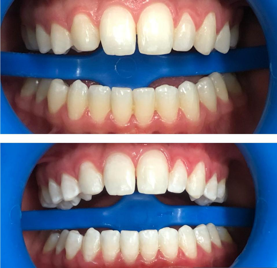 Blanqueamiento dental